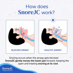 SnoreJC Premium® Anti-Snoring Mouthpiece